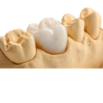 Vollkeramische Restaurationen